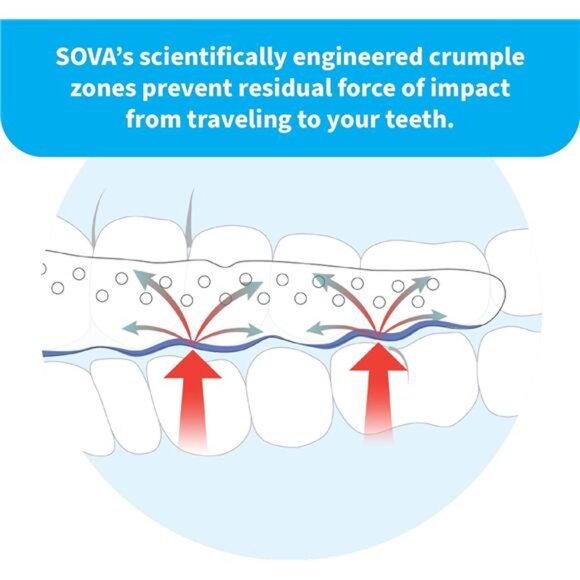 Night Guard - 1.6mm Thin - Custom-Molded Fit - Protects Nighttime Teeth Grinding - Picture 5 of 7